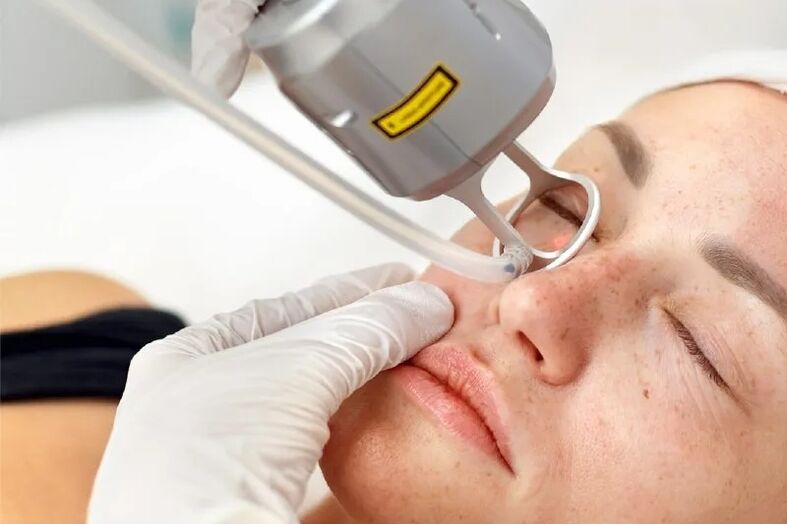 Plateforme laser pour la correction de la peau du visage. 